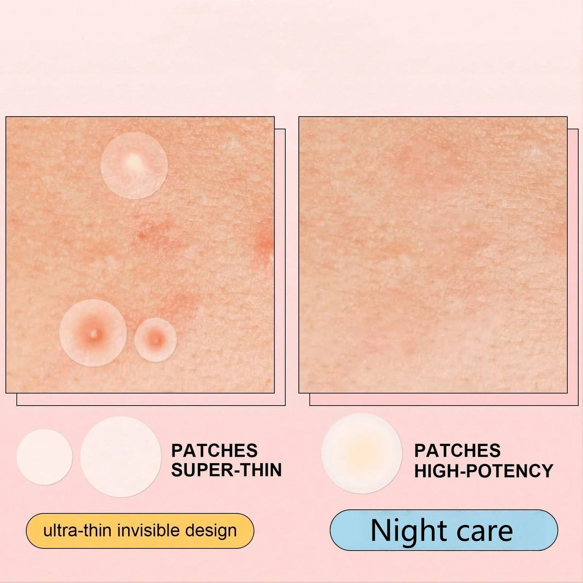 Hydrocolloid acne patches