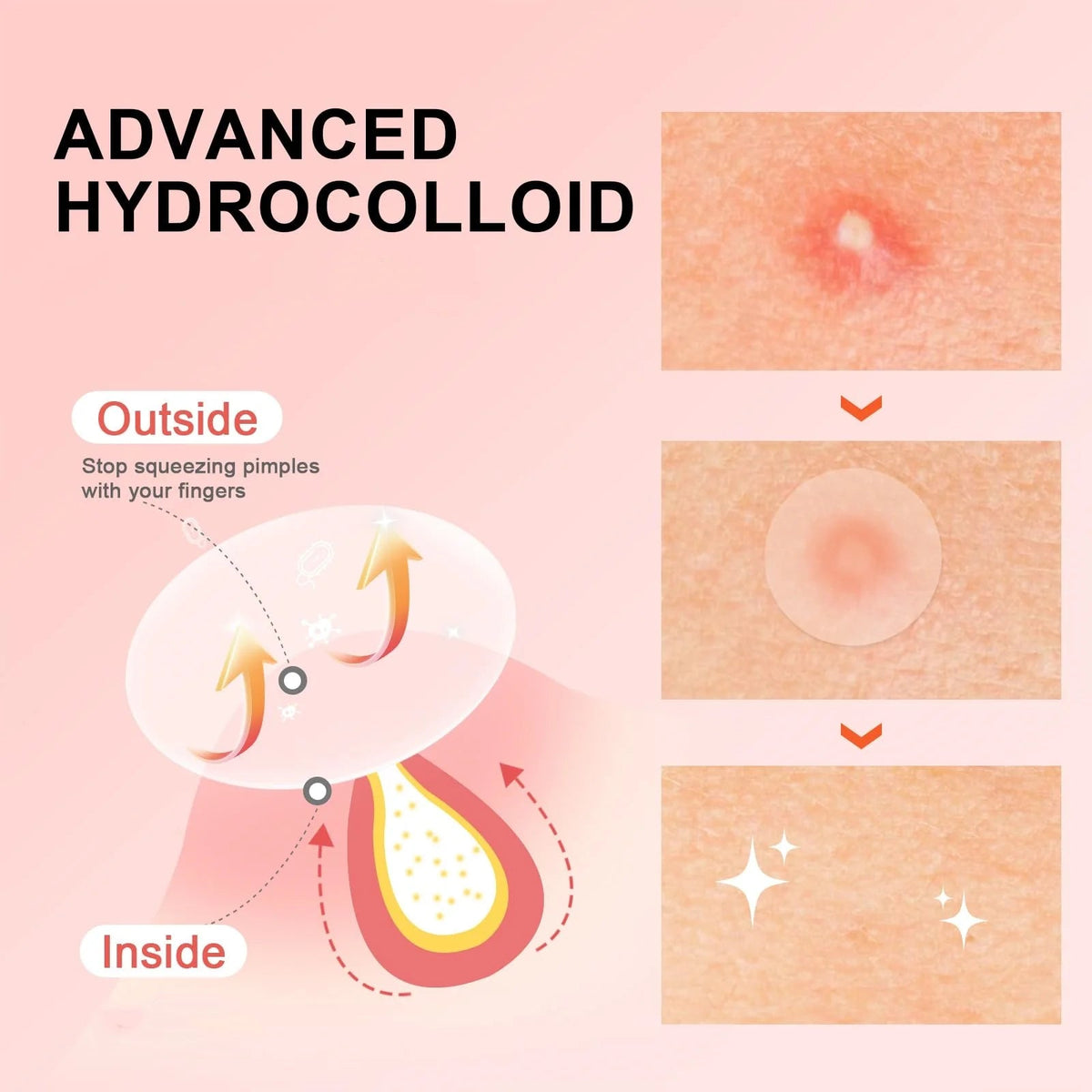 Hydrocolloid acne patches